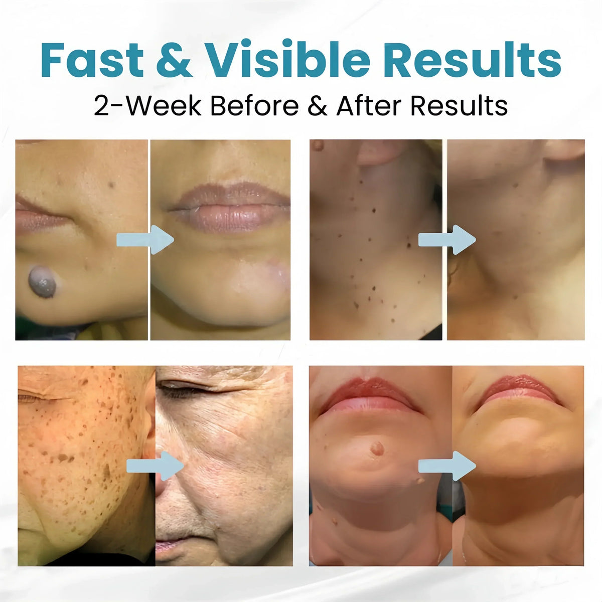 Non-Invasive Acne & Wart Removal Laser Pen with Heating (No Side Effect)